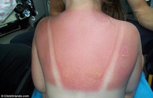 treating second degree sunburn